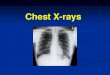 Chest X-rays...Chest X-ray Terms. Nodule – discrete opacity (usually small) Granuloma – nodule due to inflammation (e.g. past infection or foreign body/antigen); Can become fibrosed/calcified