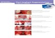 PIR - Special Edition Peri-Implant Augmentation Product range … · 2017. 6. 13. · 2 3 4 Fig. 1 An intra-operative view of surgical site 36 showing the implant site osteotomy and