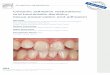 Ceramic adhesive restorations and biomimetic dentistry: tissue … · 2014. 8. 15. · and biomimetic dentistry: tissue preservation and adhesion Gil Tirlet ... a soft material, such