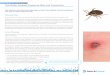 FAC T SHT Tick Bites, Disease Exposure Risk and Prevention