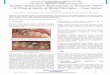 Indirect Biomimetic Restorations in Posterior Teeth - A 