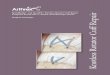 SpeedBridge™ and SpeedFix™ Knotless Rotator Cuff Repair 