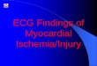ECG Findings of Myocardial Ischemia/Injury