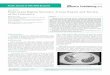 Pulmonary Kaposi Sarcoma: A Case Report and Review of the 