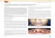 Cleft Rhinoplasty: A Surgical Technique