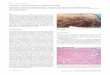 Cutaneous Necrosis Secondary to Terlipressin Therapy